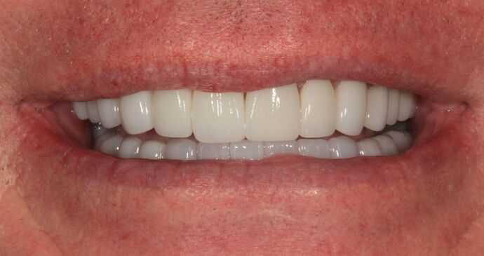 Full Mouth Reconstruction: Case 9 - After