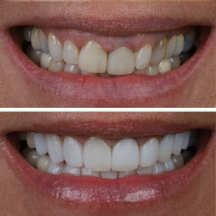 Minimal Prep Porcelain Veneers Sylvia - Before