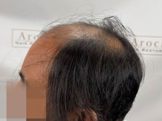Hair Transplant Results: Case 8 - Before