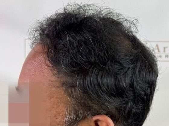 Hair Transplant Results: Case 8 - After