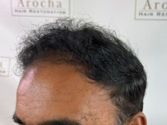 Hair Transplant Results: Case 8 - After