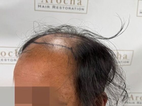 Hair Transplant Results: Case 8 - Before
