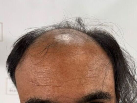 Hair Transplant Results Case 8 - Before