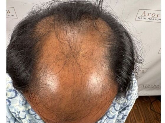 Hair Transplant Results: Case 8 - Before