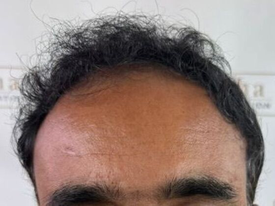Hair Transplant Results Case 8 - After
