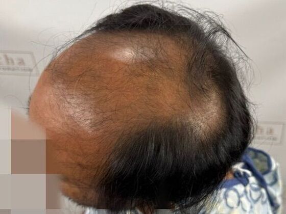 Hair Transplant Results: Case 8 - Before
