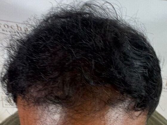 Hair Transplant Results: Case 8 - After