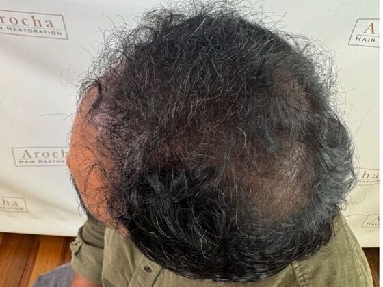 Hair Transplant Results: Case 8 - After