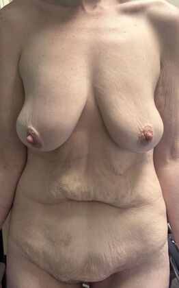 Massive Weight Loss : Case 210 - Before