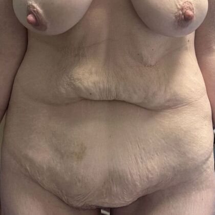 Tummy Tuck (Abdominoplasty): Case 585 - Before