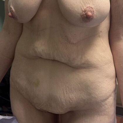 Tummy Tuck (Abdominoplasty): Case 585 - Before