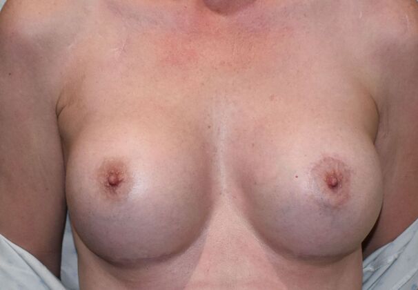 Breast Augmentation: Case 815 - After
