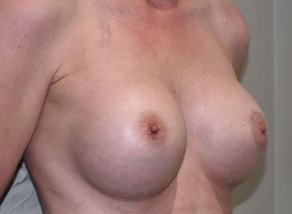 Breast Augmentation: Case 815 - After