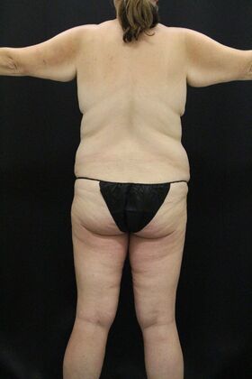 Tummy Tuck: Case 90 - Before