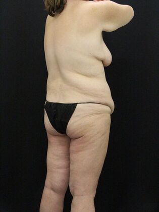 Tummy Tuck: Case 90 - Before