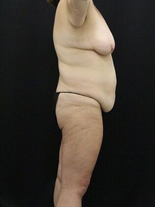 Tummy Tuck: Case 90 - Before