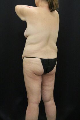 Tummy Tuck: Case 90 - Before