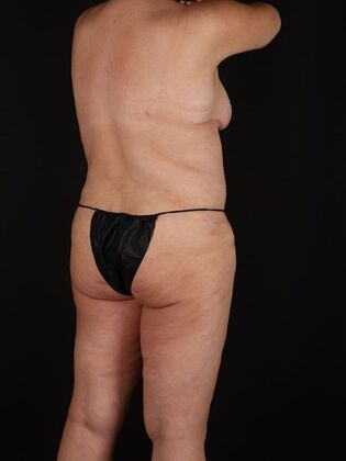 Tummy Tuck: Case 90 - After