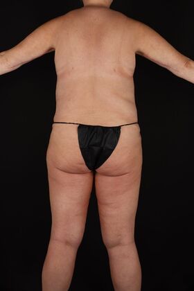 Tummy Tuck: Case 90 - After