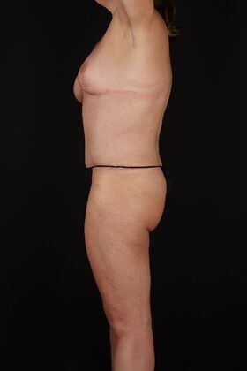 Tummy Tuck: Case 90 - After