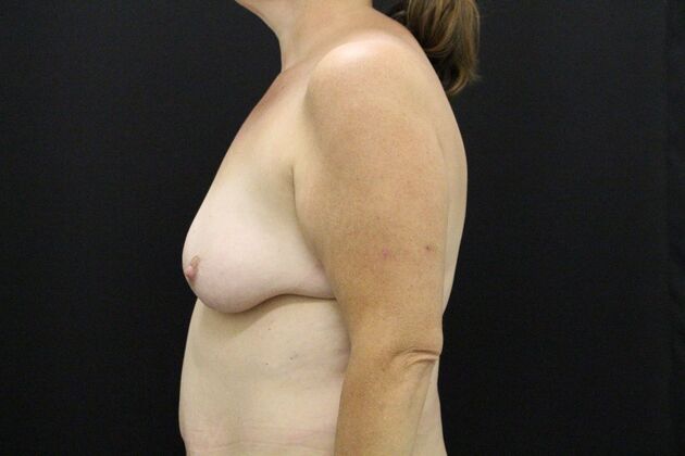 Breast Reduction & Lift: Case 43 - Before