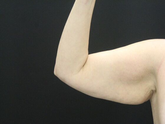 Arm Lift & Reduction Case 18 - Before