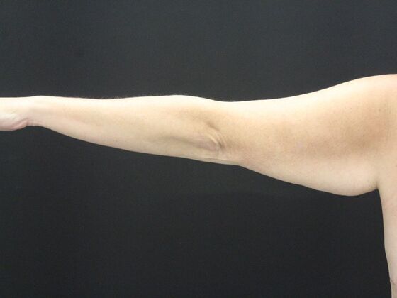 Arm Lift & Reduction: Case 18 - Before