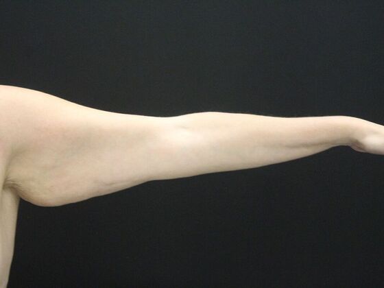 Arm Lift & Reduction: Case 18 - Before