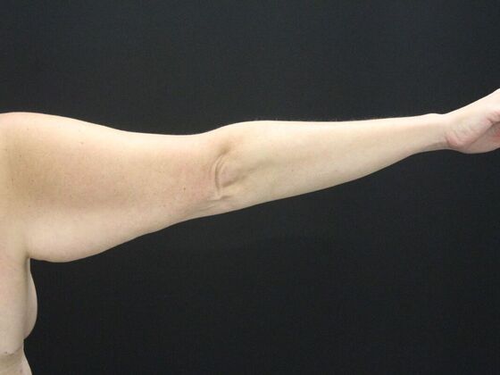 Arm Lift & Reduction: Case 18 - Before