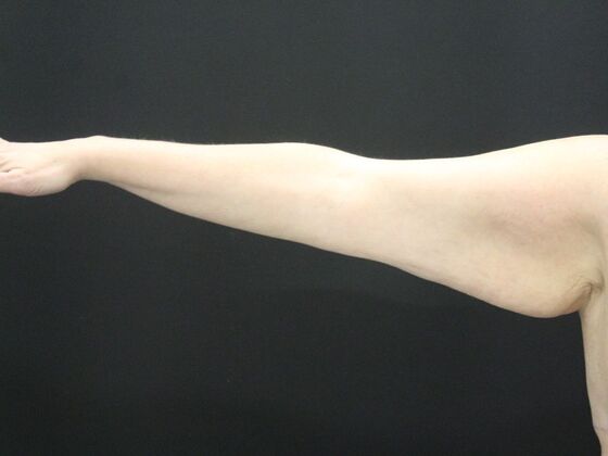 Arm Lift & Reduction: Case 18 - Before