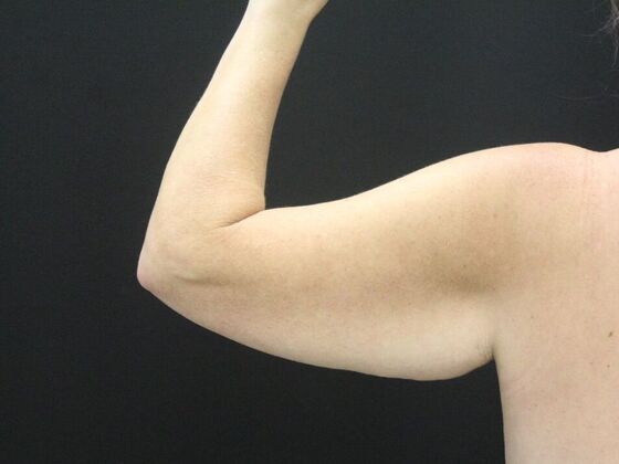 Arm Lift & Reduction: Case 18 - Before
