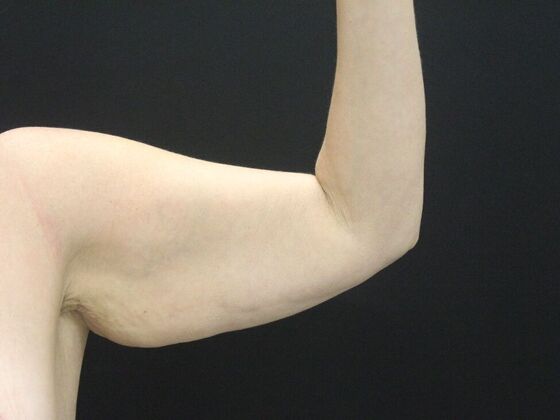 Arm Lift & Reduction: Case 18 - Before
