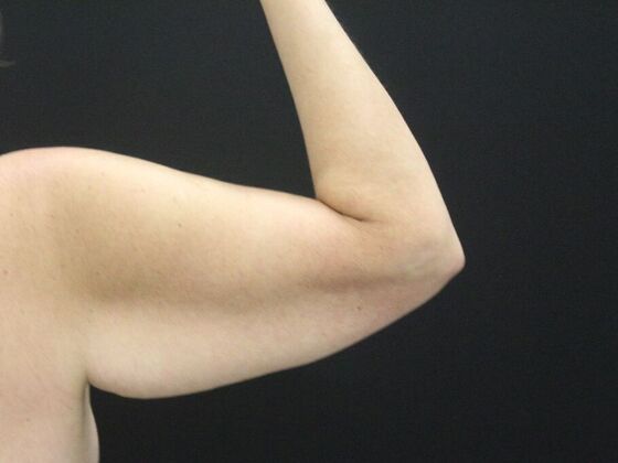 Arm Lift & Reduction: Case 18 - Before