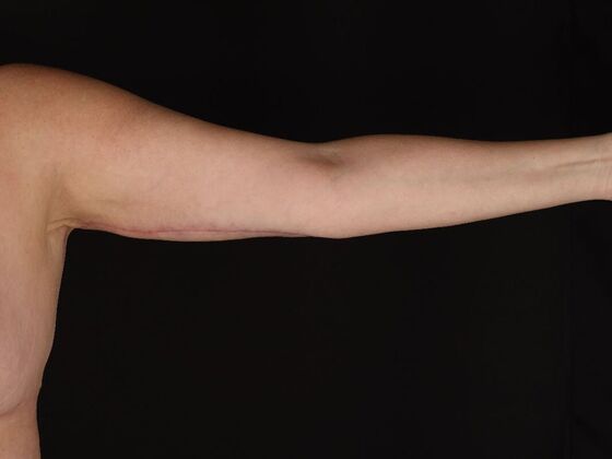 Arm Lift & Reduction: Case 18 - After