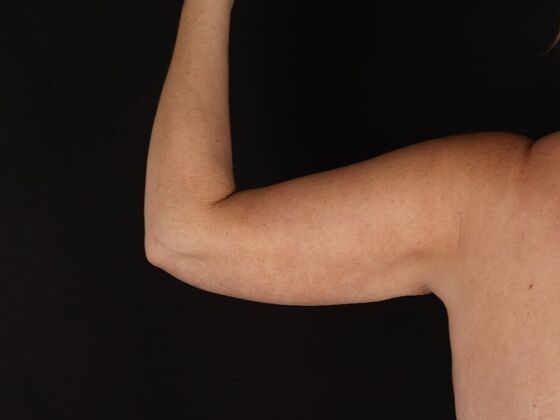 Arm Lift & Reduction: Case 18 - After