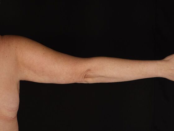 Arm Lift & Reduction: Case 18 - After