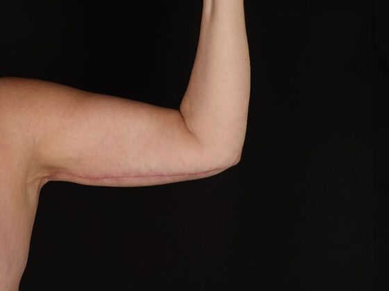 Arm Lift & Reduction: Case 18 - After