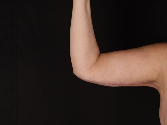 Arm Lift & Reduction Case 18 - After