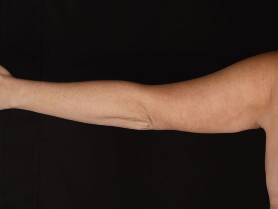 Arm Lift & Reduction: Case 18 - After