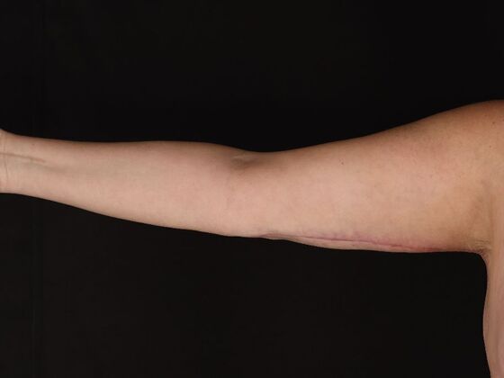 Arm Lift & Reduction: Case 18 - After