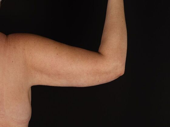 Arm Lift & Reduction: Case 18 - After