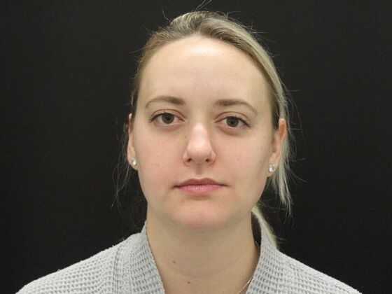 Liposuction: Case 76 - Before