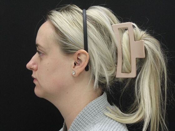 Liposuction: Case 76 - Before