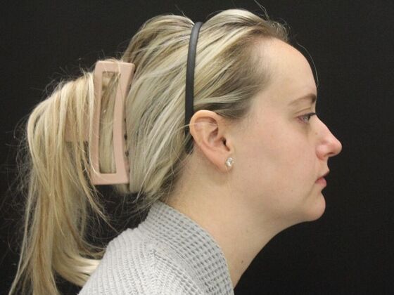 Liposuction Case 76 - Before