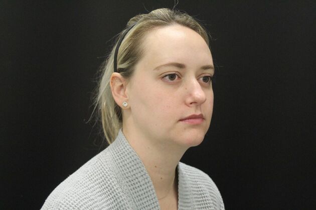 Liposuction: Case 76 - Before