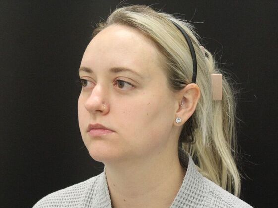 Liposuction: Case 76 - Before