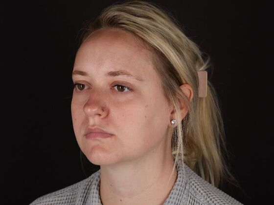 Liposuction: Case 76 - After