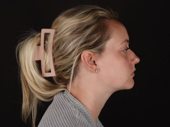 Liposuction Case 76 - After