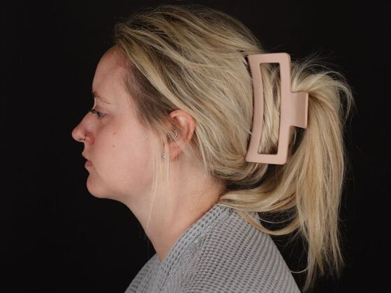 Liposuction: Case 76 - After