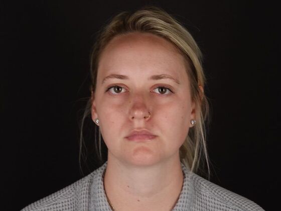 Liposuction: Case 76 - After